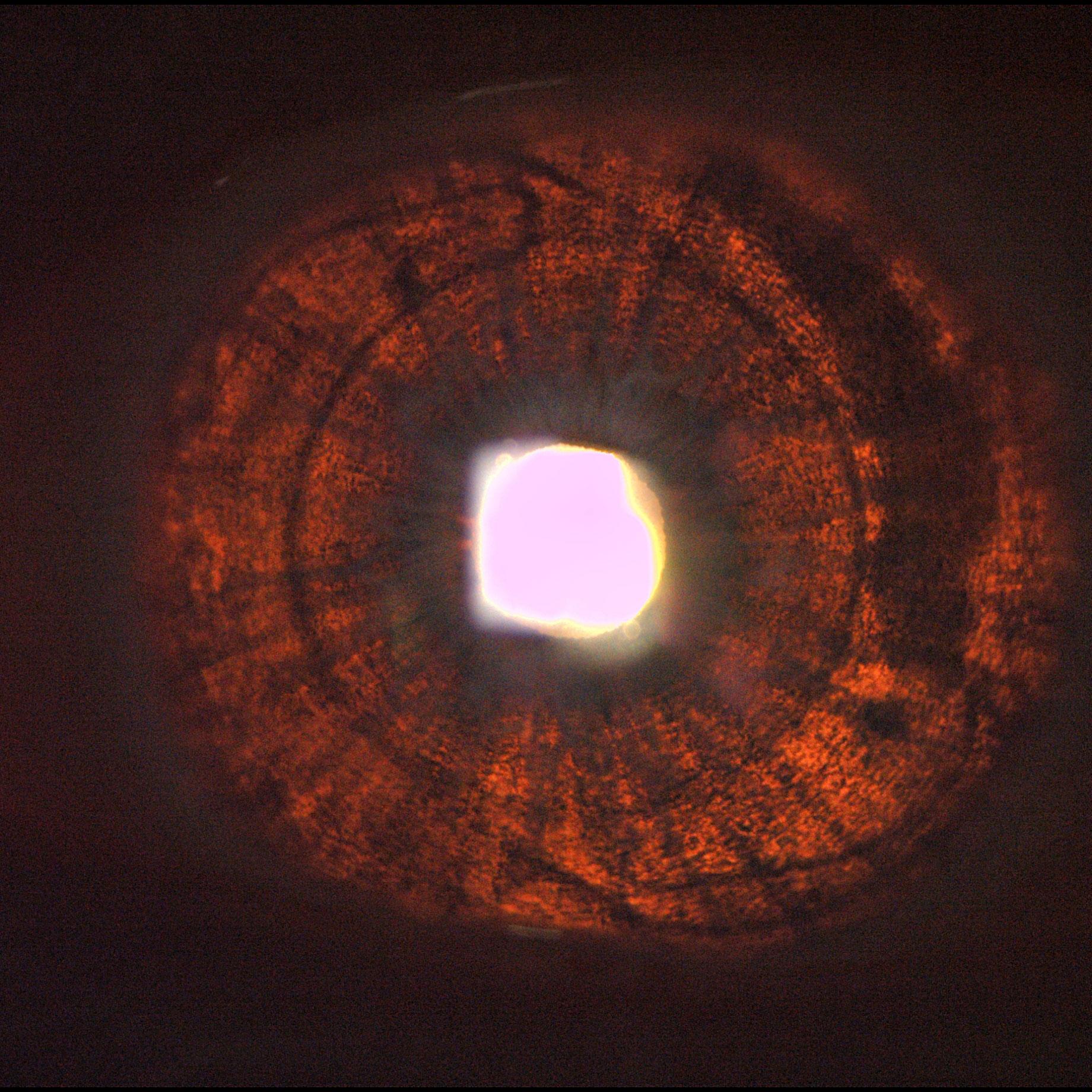 Transillumination of the iris in albinism and pseudophakia