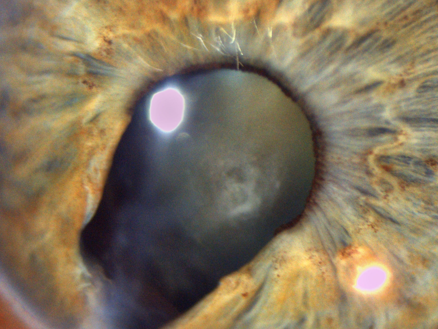 Traumatic coloboma of the iris and cataract as sequelae of penetrating injury 