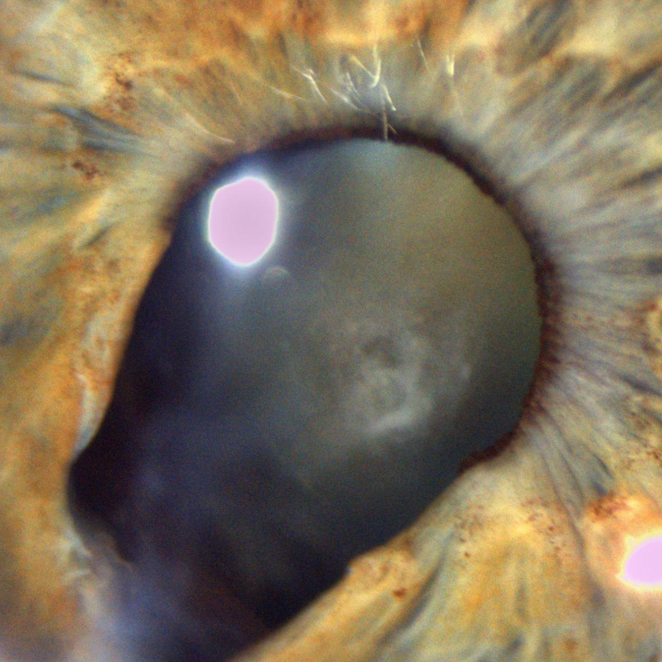 Traumatic coloboma of the iris and cataract as sequelae of penetrating injury 