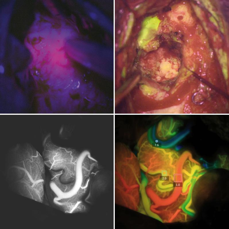 Tecnologias de fluorescência intraoperatória ZEISS 