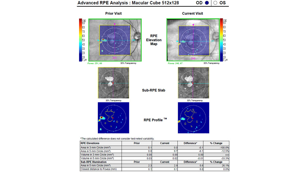 ZEISS Cirrus 6000 Advanced RPE Analysis | ZEISS Medical