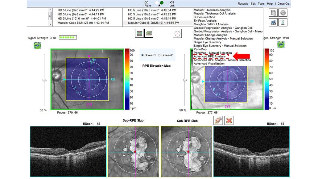 Advanced RPE Analysis