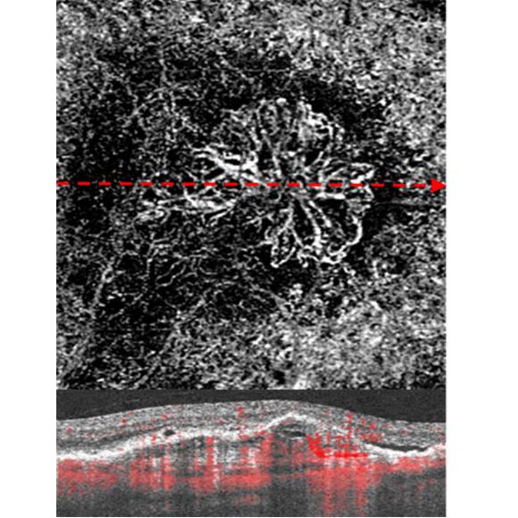 Angiogramme OCT d'une néovascularisation maculaire exsudative