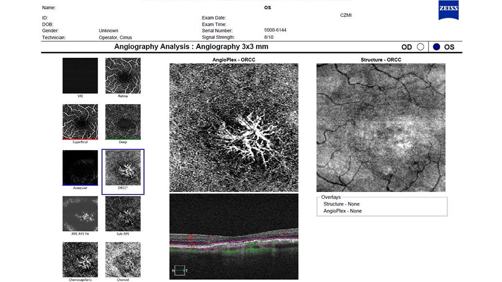 Angiographie OCT d'une néovascularisation maculaire exsudative observée sur la tranche ORCC