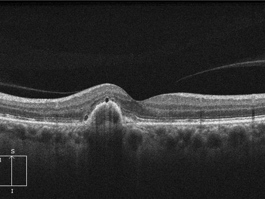 Age related macular degeneration (AMD)
