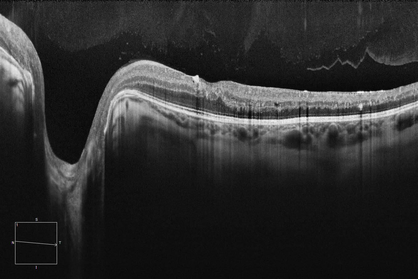 ZEISS CIRRUS 6000 12 mm HD 1 Line raster 100x averaged