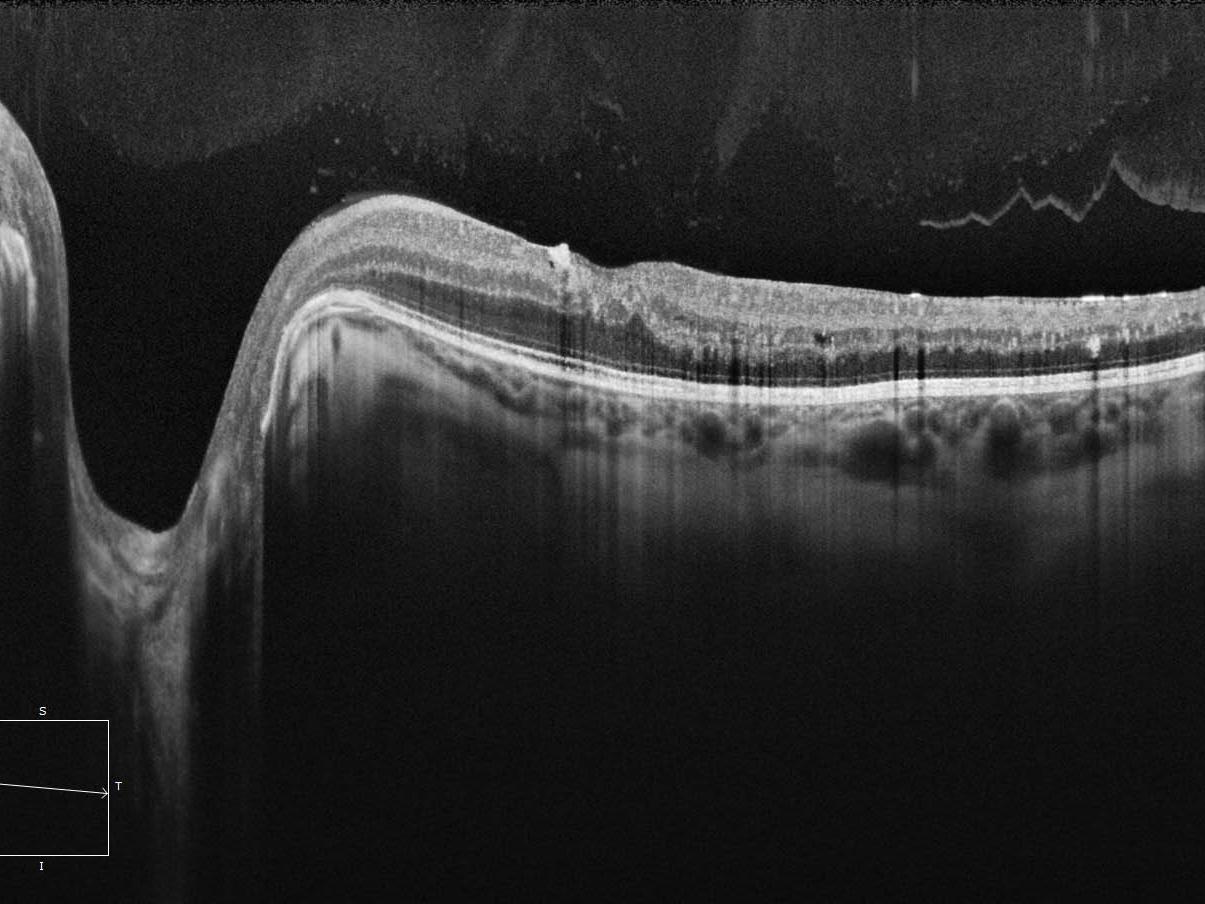 ZEISS CIRRUS 6000 12 mm HD 1 Line raster 100x averaged