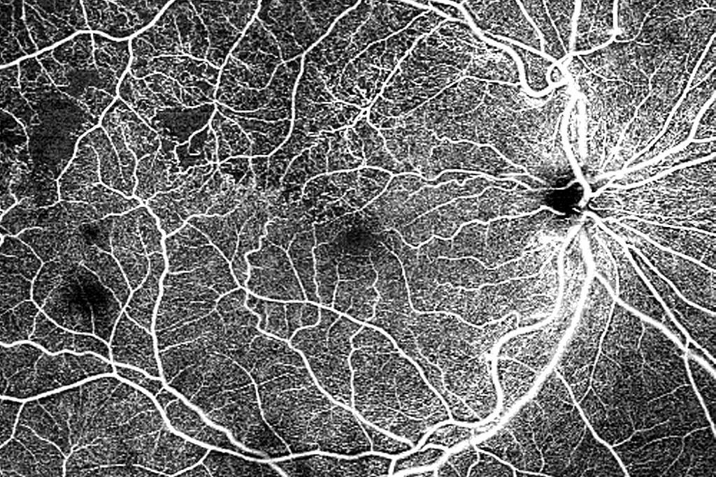 ZEISS CIRRUS 6000 12x12 mm single-shot AngioPlex OCT Angiography of branch retinal vein occlusion (BRVO)