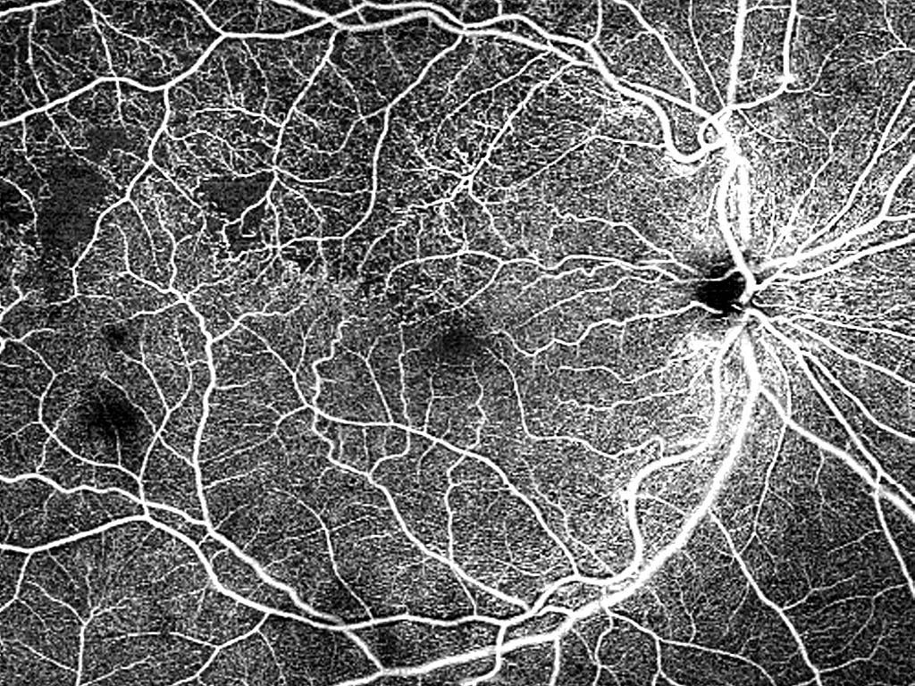 ZEISS CIRRUS 6000 12x12 mm single-shot AngioPlex OCT Angiography of branch retinal vein occlusion (BRVO)