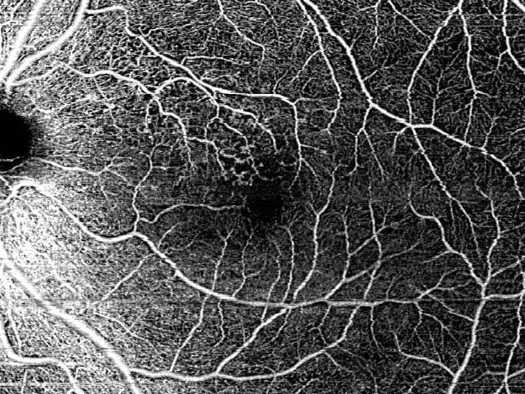 ZEISS CIRRUS 6000 8x8 mm HD AngioPlex OCT Angiography of proliferative diabetic retinopathy, PDR