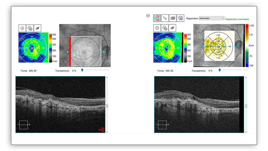 Image of Macular change analysis
