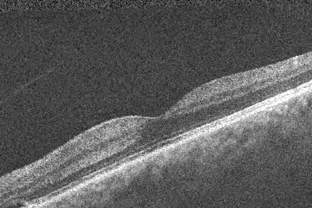 Rolling b-scan averaging for noise reduction and improved layer detail