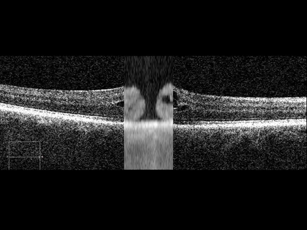 Indications sur les pathologies maculaires grâce à Fixation Check 