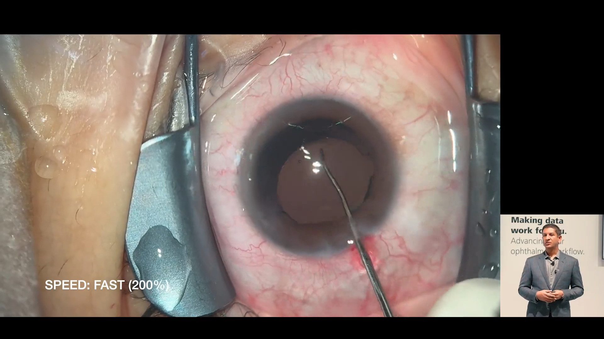 Dr. Desai’s First Experience with ZEISS MICOR 700