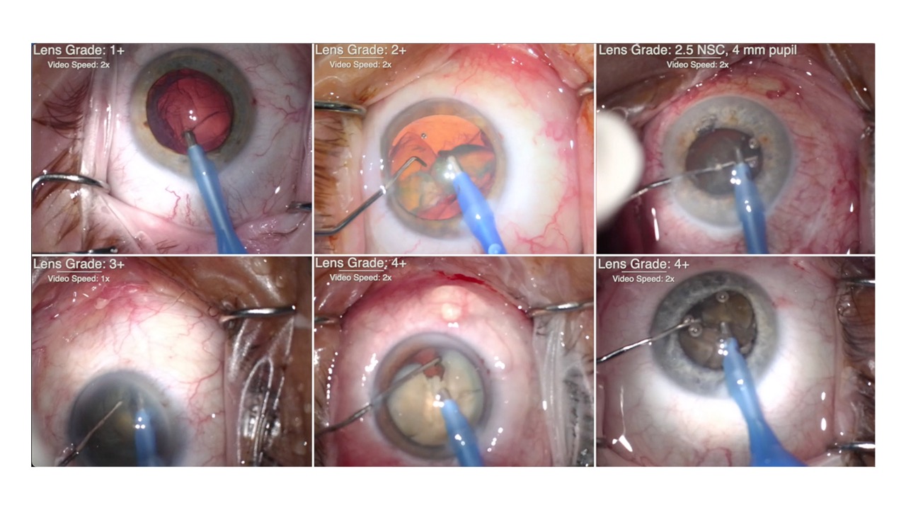 Dr. Yeu’s Cataract Removal Cases with ZEISS MICOR 700