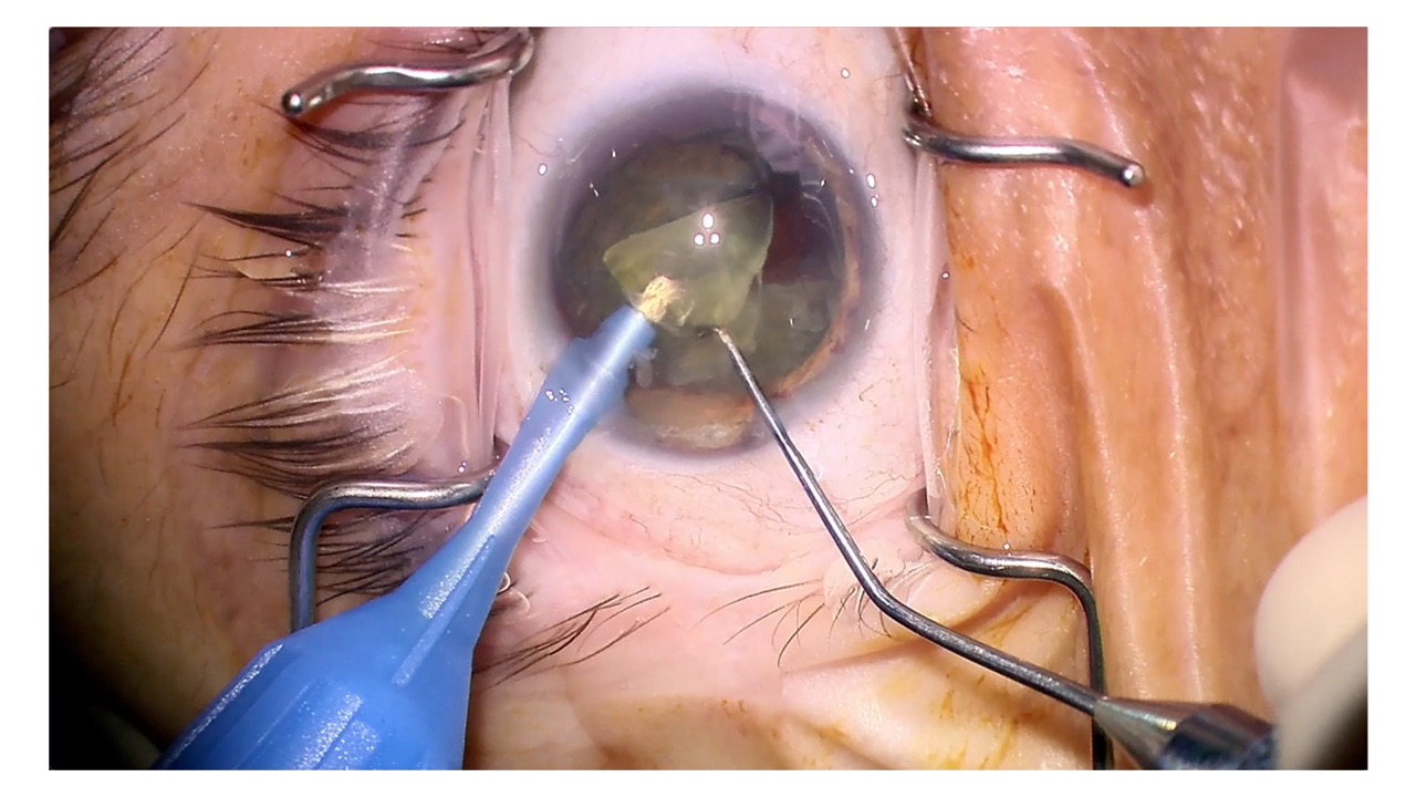 Dr. Pantanelli’s Cataract Removal Case with ZEISS MICOR 700