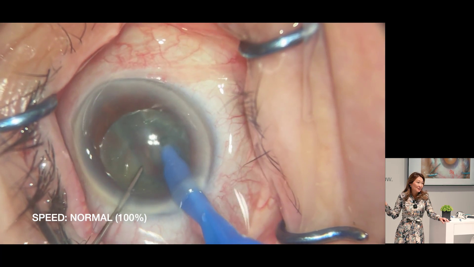 Dr. Yoo’s First Experience with ZEISS MICOR 700