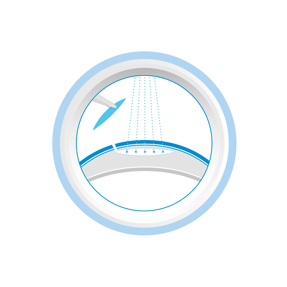 ZEISS SMILE – Femtosecond Laser Solutions, image size:1000x1000