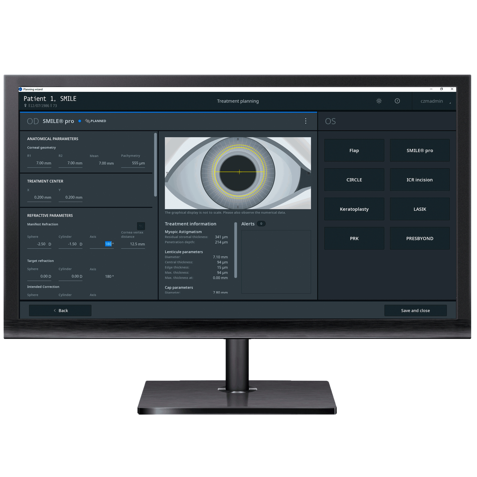 Image of ZEISS Refractive Workplace on a monitor