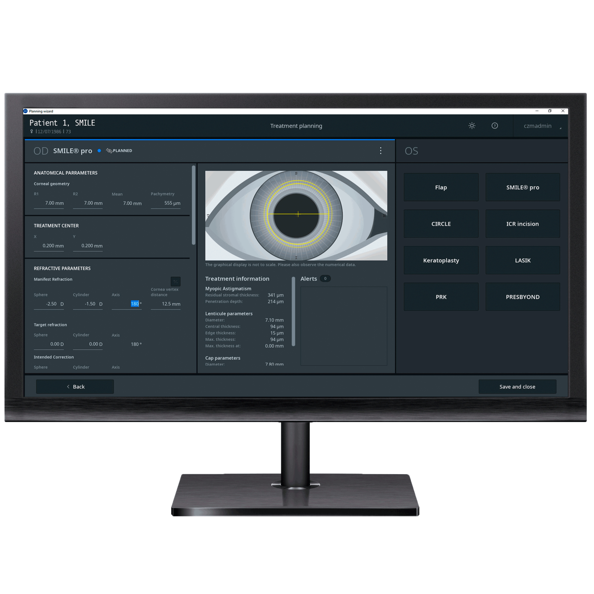 Imagem do ZEISS Refractive Workplace num monitor