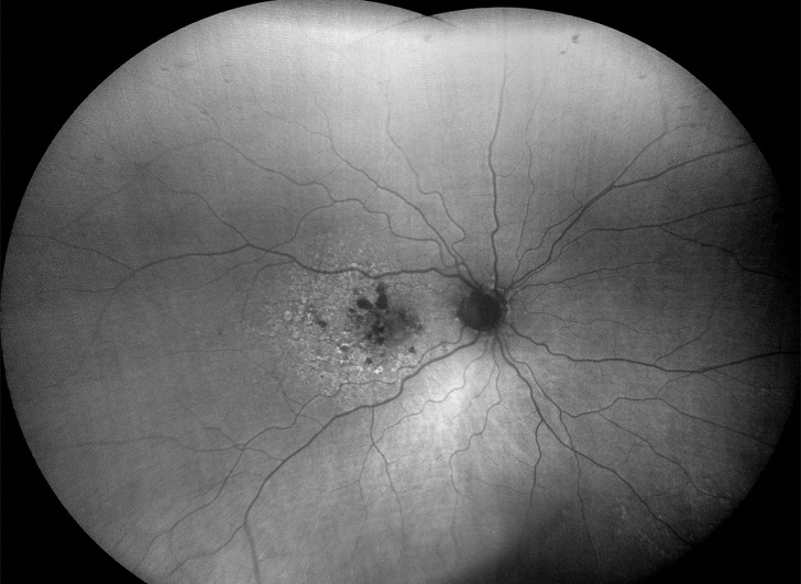 FAF-Green image of dry age-related macular degeneration