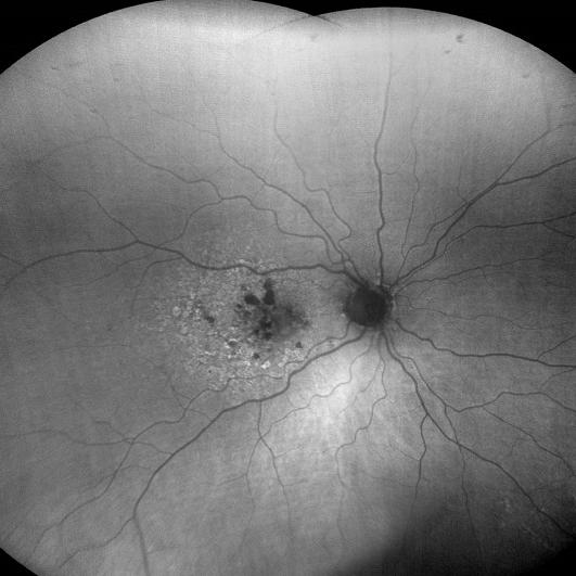 FAF-Green image of dry age-related macular degeneration