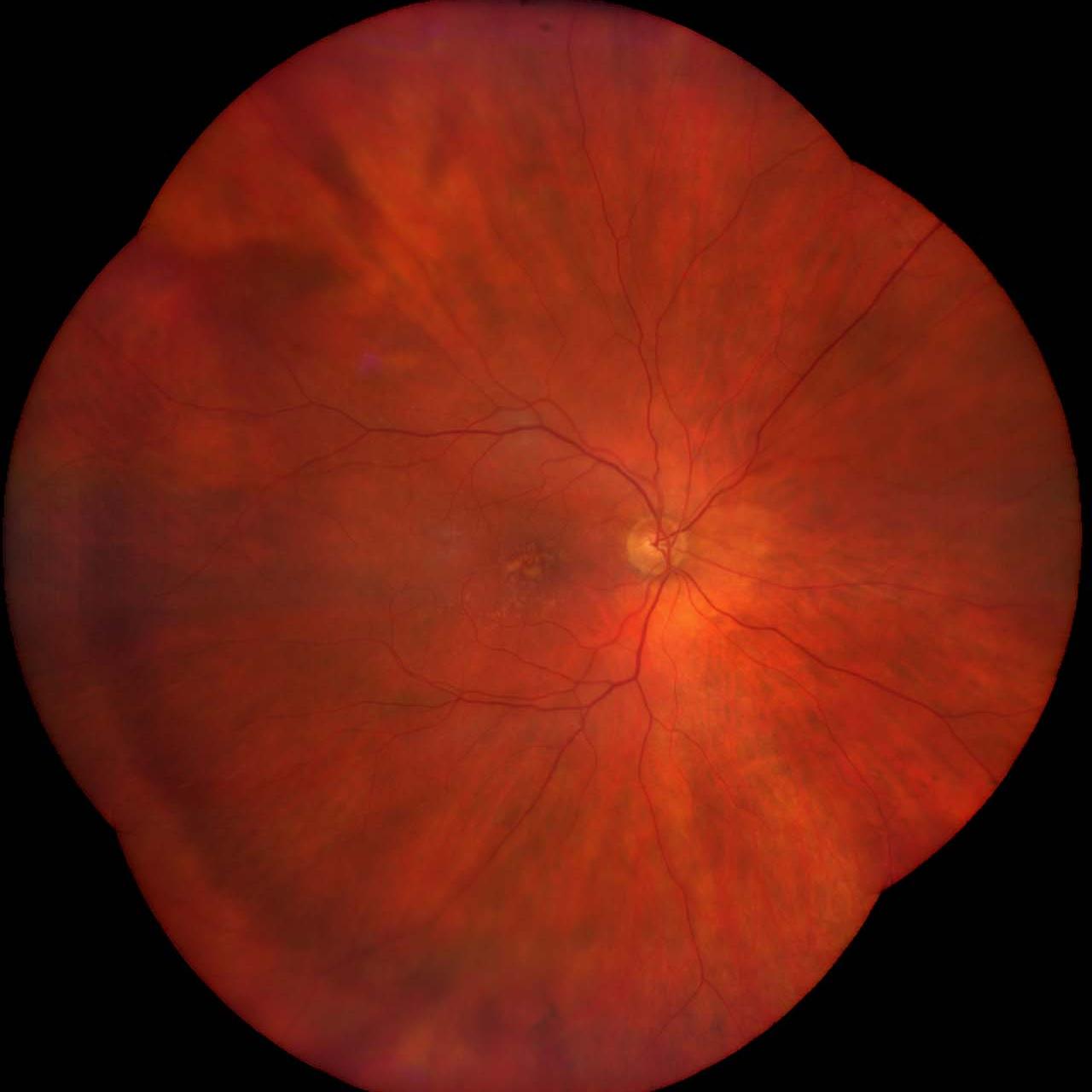 Dry age-related macular degeneration