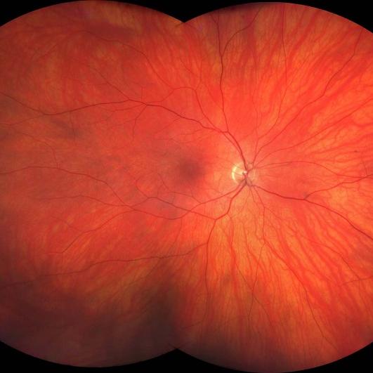 Ultra-widefield image of a healthy eye