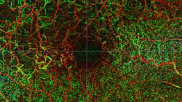 BRVO with macular edema