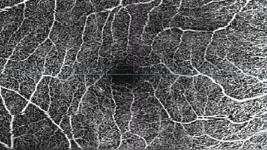 Central serous chorioretinopathy (CSC)