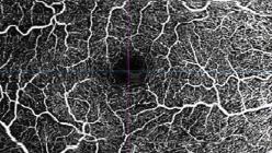 Neovascular age-related macular degeneration (AMD) with cystoid macular edema post-cataract surgery