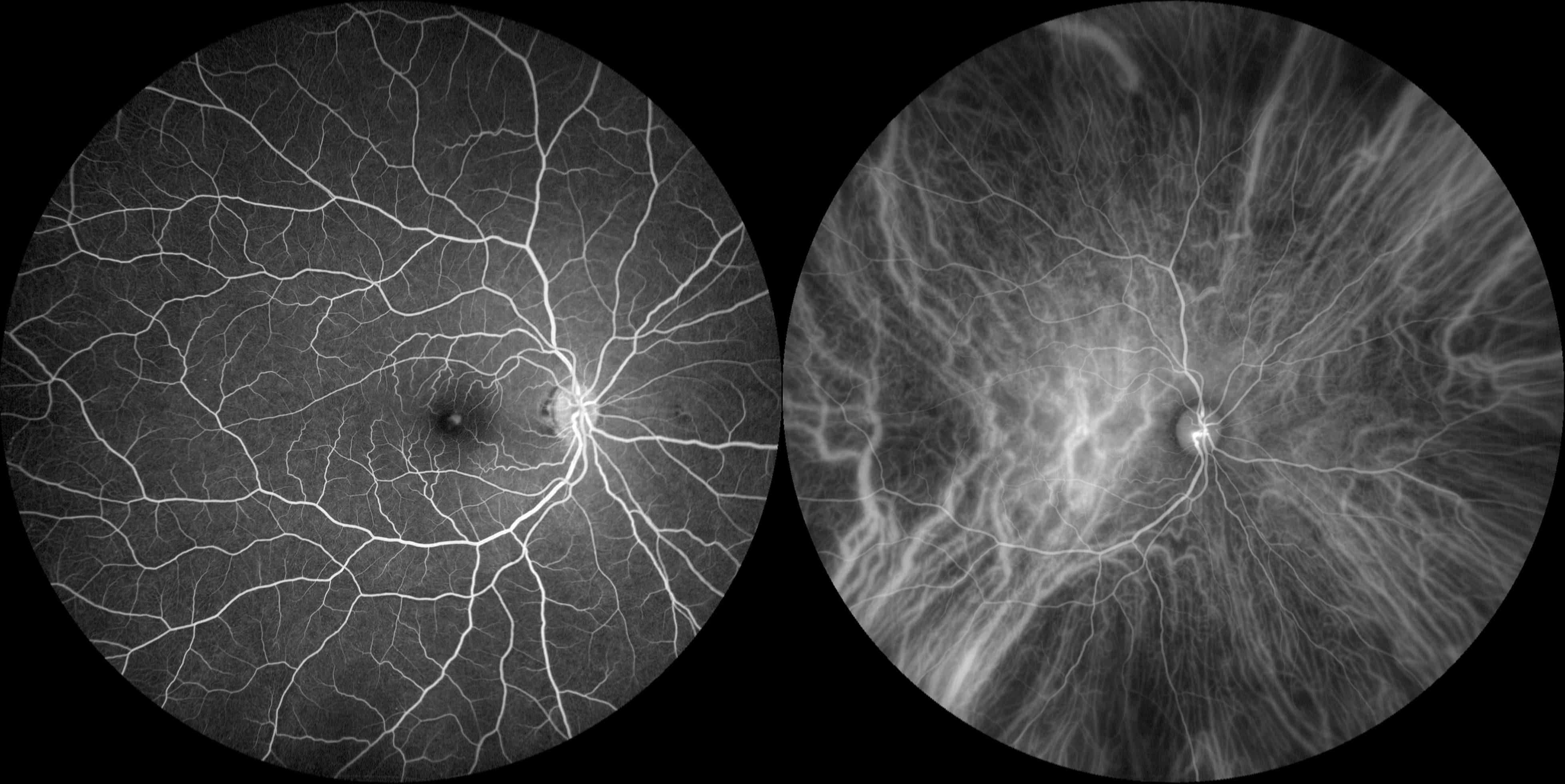 Angiography