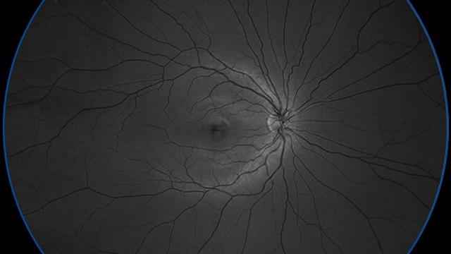 Blue channel separation image increases visibility of anterior retinal layer