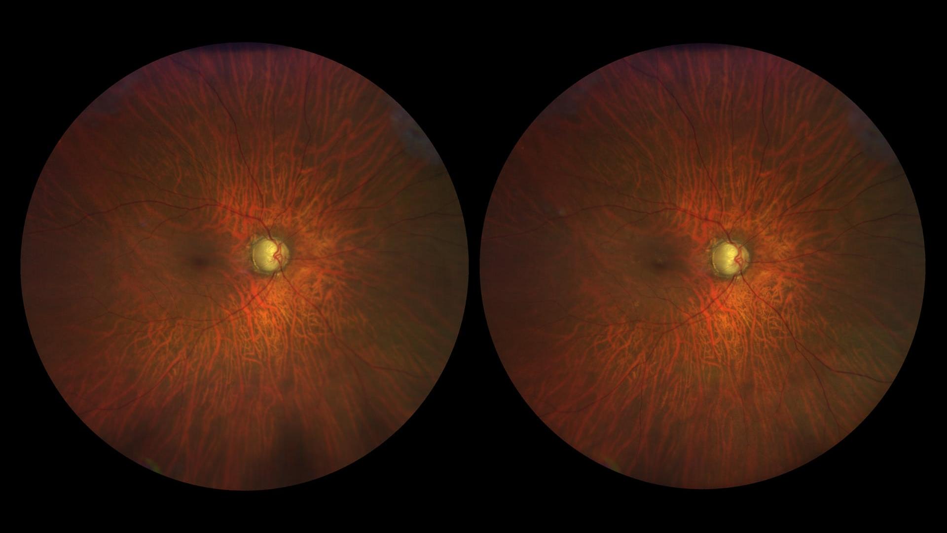 Stereo image pairs can be captured for stereoscopic evaluation of the fundus