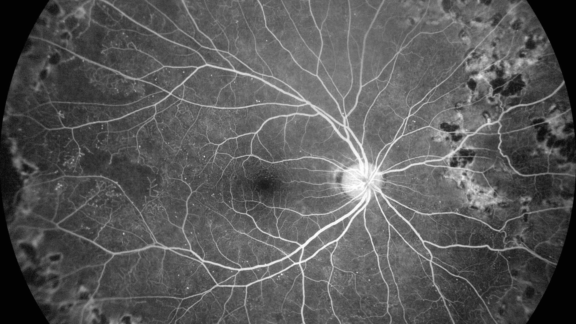 Fluorescein Angiography of a proliferative diabetic retinopathy