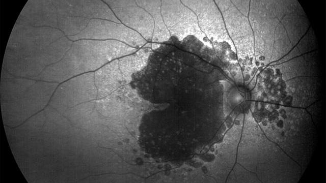 FAF-Blue image of geographic atrophy 