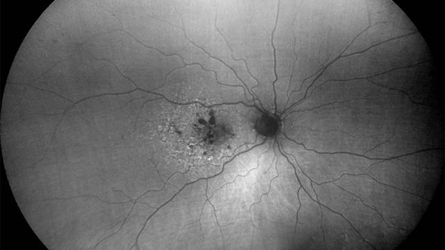 FAF-Green image of dry age-related macular degeneration