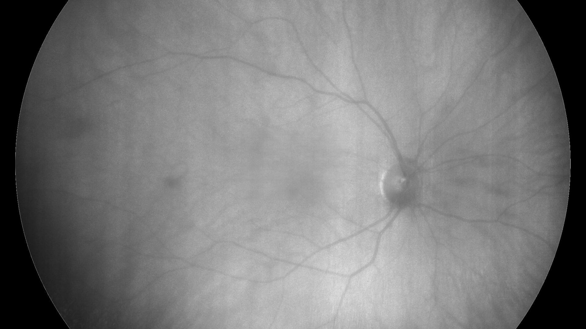 Infrared image of a healthy eye
