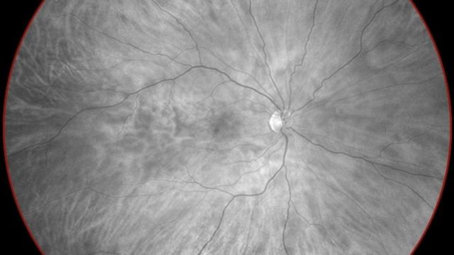 Red channel separation image reveals the choroid in more detail