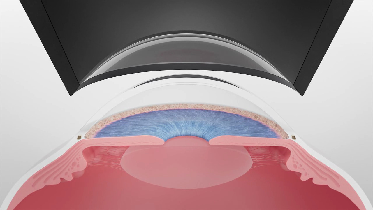 VISULAS green mit ZEISS SLT  