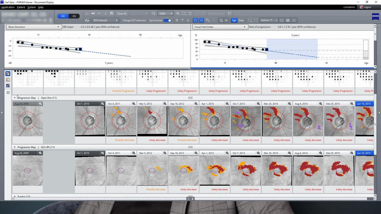 VISULAS green mit ZEISS SLT  