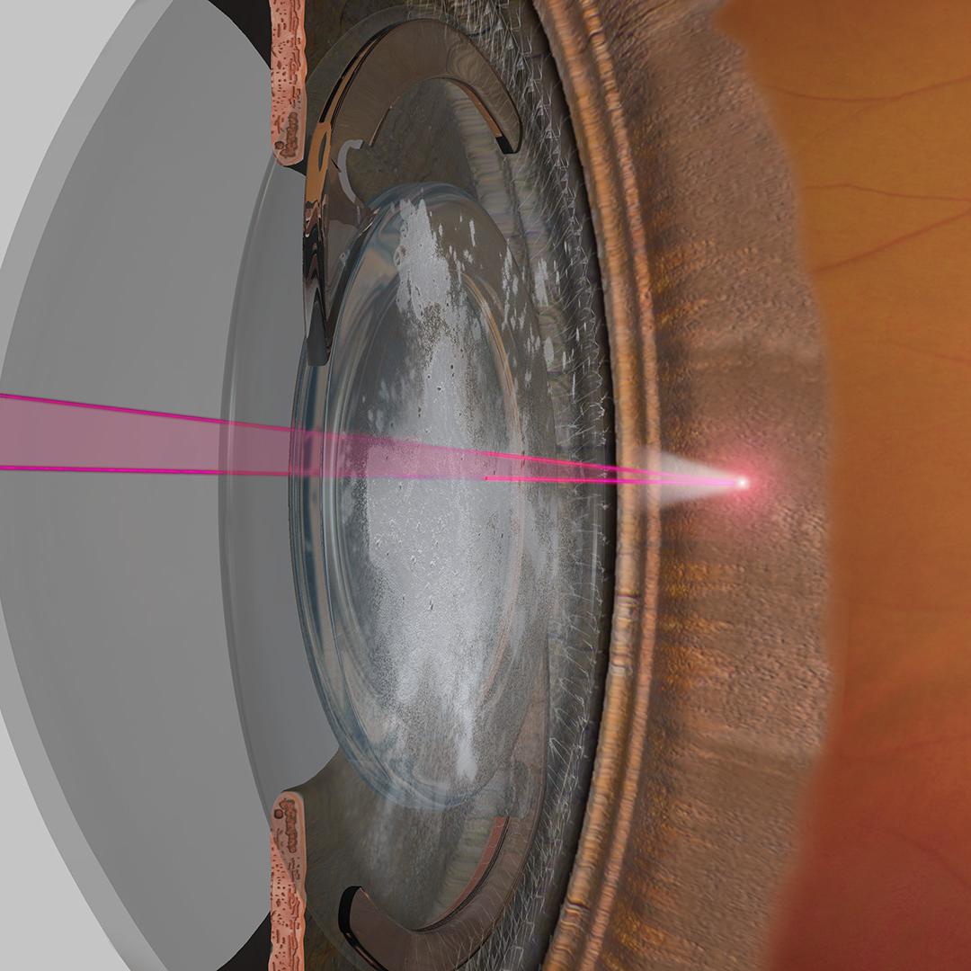 Traitement de haute précision VISULAS yag