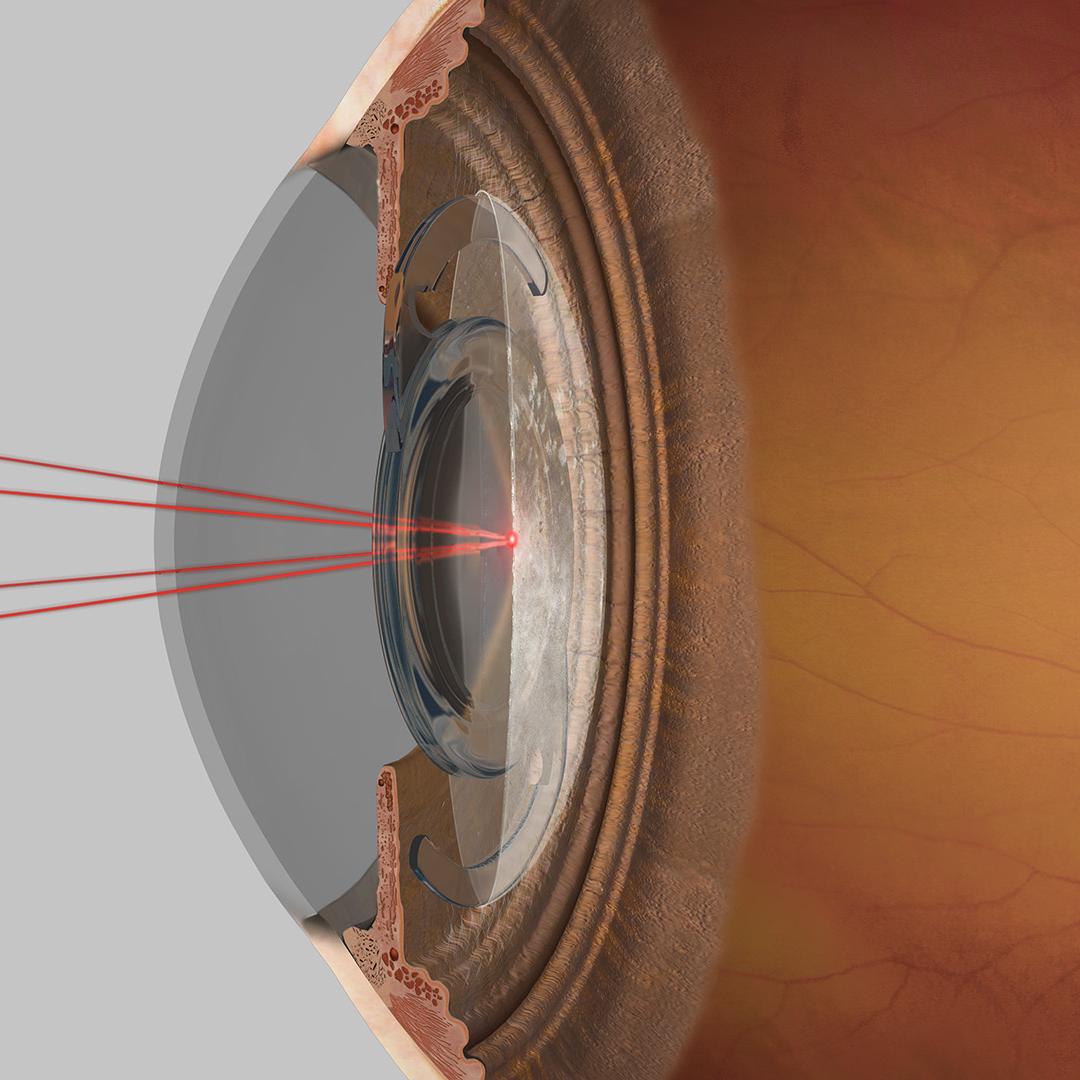 Sistema de feixe de mira com quatro pontos VISULAS yag