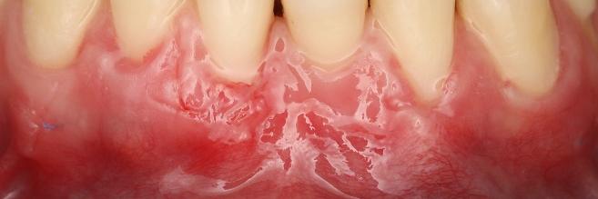 Mucogingival surgery