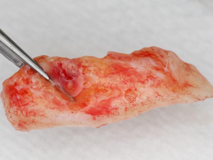 Before meticulous graft preparation
