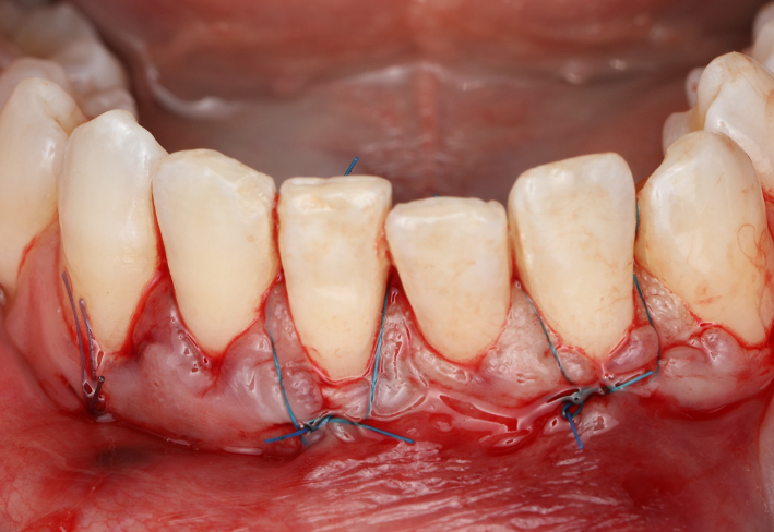 Complex suturing system