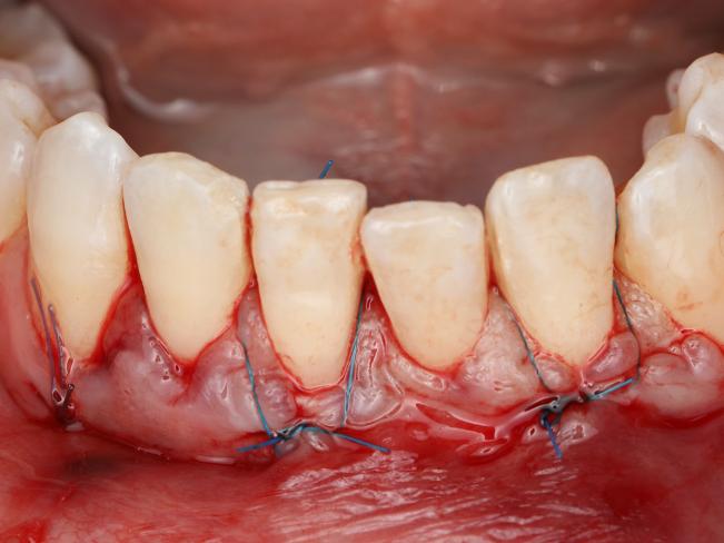 Complex suturing system