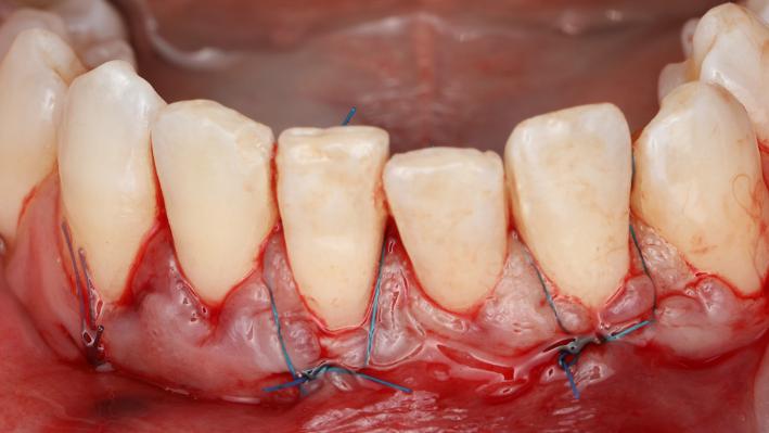 Complex suturing system