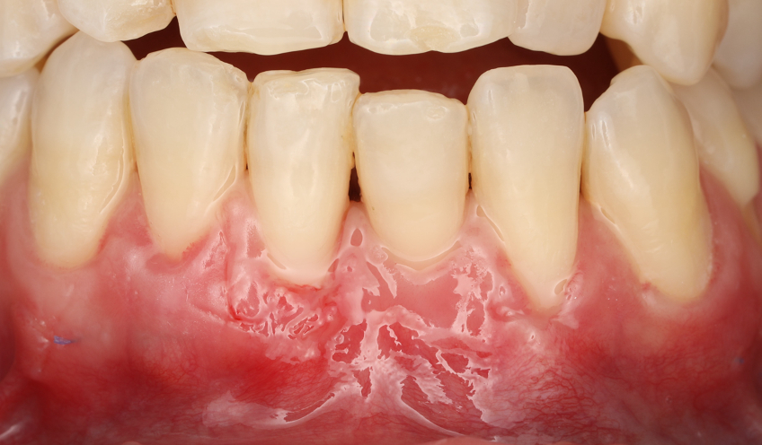  cirurgia mucogengival: após 10 dias