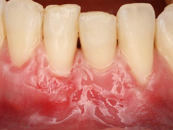 Mucogingival surgery